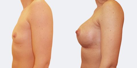 6 plasticka chirurgie prirozene zvetseni bok pred