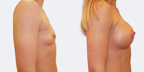 6 plasticka chirurgie prirozene zvetseni bok2 pred