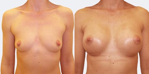 6 plasticka chirurgie prirozene zvetseni zepredu pred