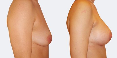 12 pouziti kulatych implantatu bok2 pred