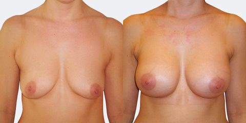 12 pouziti kulatych implantatu predek pred