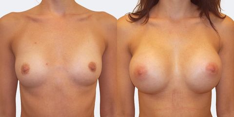 6 pouziti kulatych implantatu predek pred