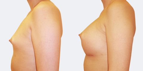 4 plasticka chirurgie vyrazne zvetseni bok pred
