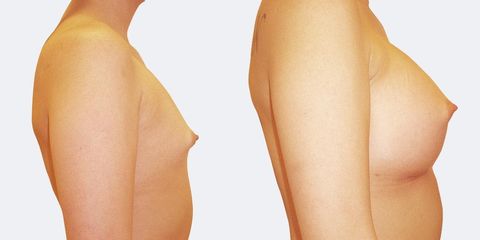 4 plasticka chirurgie vyrazne zvetseni bok2 pred