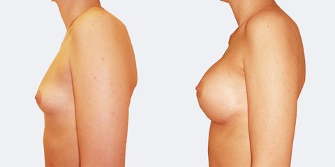 7 plasticka chirurgie prirozene zvetseni bok pred