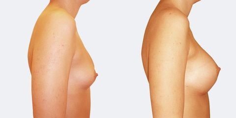 7 plasticka chirurgie prirozene zvetseni bok2 pred
