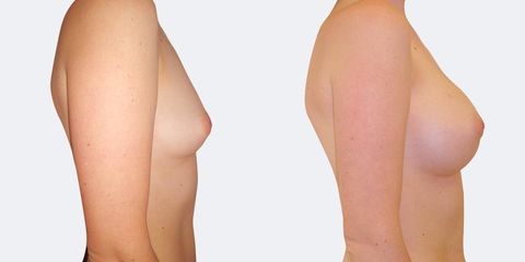 10 plasticka chirurgie prirozene zvetseni bok2 pred