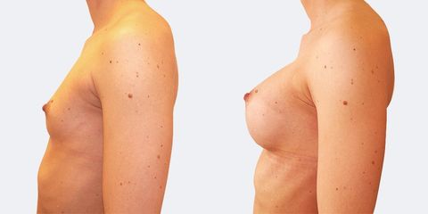 5 plasticka chirurgie prirozene zvetseni bok pred