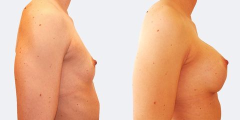 5 plasticka chirurgie prirozene zvetseni bok2 pred