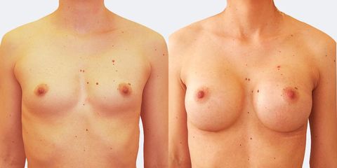 5 plasticka chirurgie prirozene zvetseni zepredu pred
