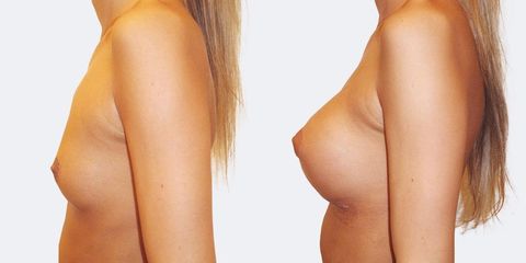13 pouziti kulatych implantatu bok pred