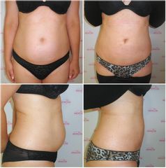 Liposukce - Prim. MUDr. Petr Pachman - MEDICOM Clinic