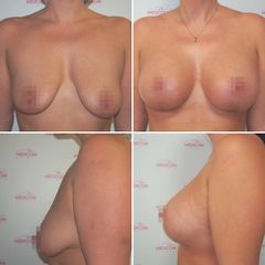 Modelace prsou - Prim. MUDr. Petr Pachman - MEDICOM Clinic
