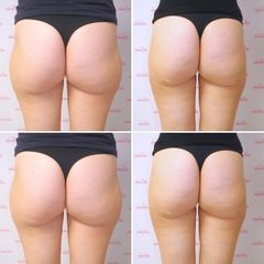 Laserová Liposukce - Prim. MUDr. Petr Pachman - MEDICOM Clinic