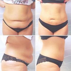 Laserová Liposukce - Prim. MUDr. Petr Pachman - MEDICOM Clinic