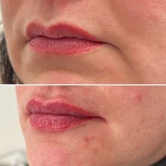 Zvětšení rtů kyselinou hyaluronovou - Dermaline Clinic
