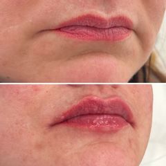 Zvětšení rtů kyselinou hyaluronovou - Dermaline Clinic