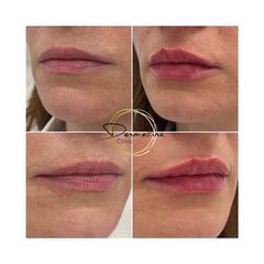 Zvětšení rtů kyselinou hyaluronovou - Dermaline Clinic