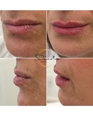 Zvětšení rtů kyselinou hyaluronovou - Dermaline Clinic