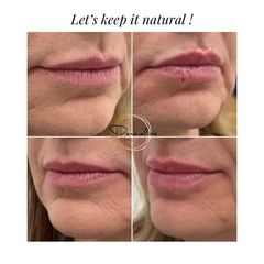 Zvětšení rtů kyselinou hyaluronovou - Dermaline Clinic