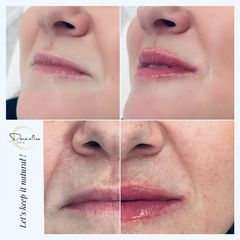 Zvětšení rtů kyselinou hyaluronovou - Dermaline Clinic