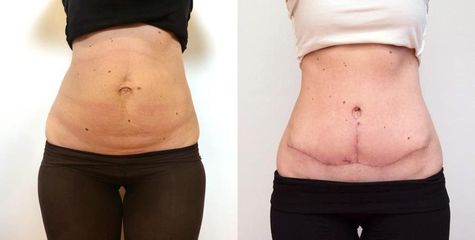 1413299767Plasticka abdominoplastika 3a pred