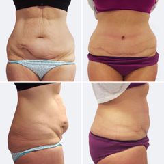 Abdominoplastika - MUDr. Michal Puls CSc. - MEDICOM Clinic