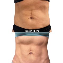 Emsculpt Neo - BOMTON CLINIC, s.r.o.