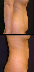 abdominoplasika5