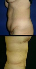 abdominoplasika6