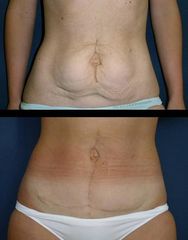 abdominoplasika7