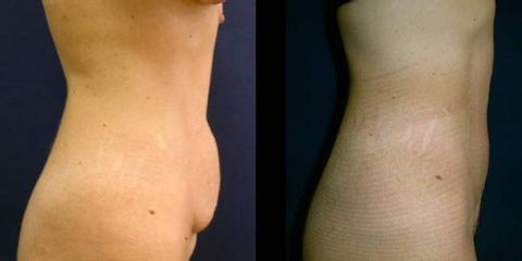 abdominoplasika8