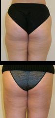 lipo