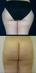 lipo1