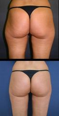 lipo3
