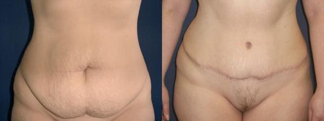 abdominoplastika db