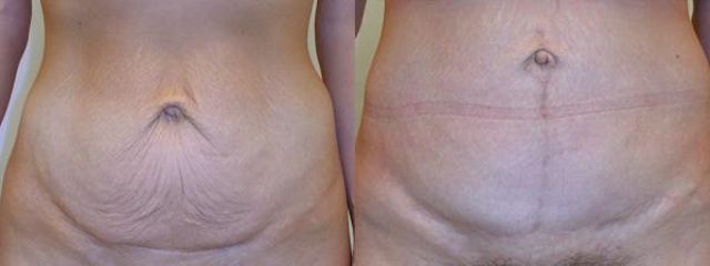 abdominoplastika jj