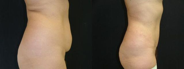 abdominoplastika jr