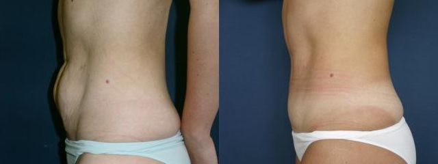 abdominoplastika lp1