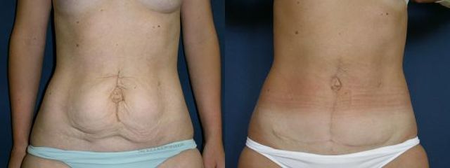 abdominoplastika lp2