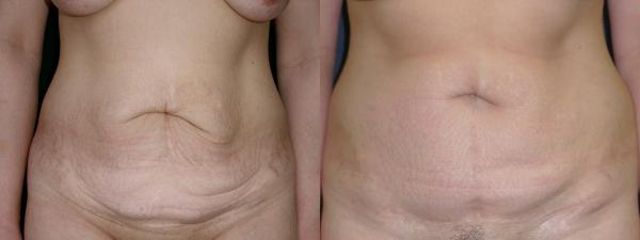 abdominoplastika mr