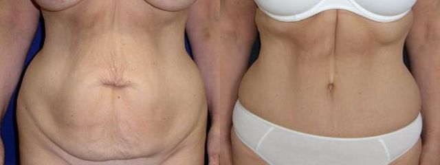 abdominoplastika sm1