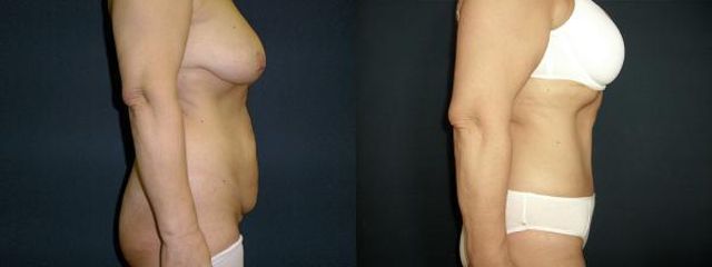abdominoplastika sm2