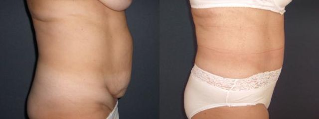 abdominoplastika smb1