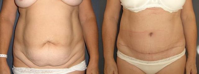 abdominoplastika smb2