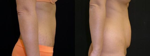 abdominoplastika vm