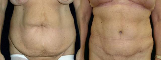 abdominoplastika vo