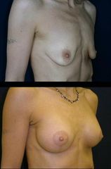modelace s implantaty7