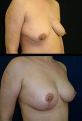 modelace s implantaty1