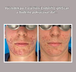 Laserová léčba akné - MUDr. Drahomíra Kotlářová